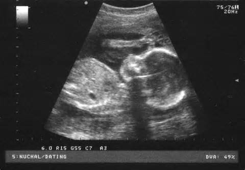sonogram